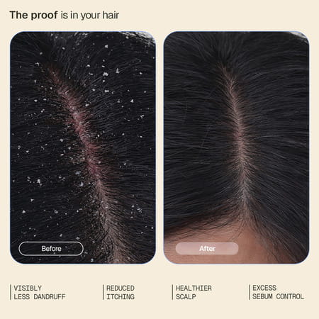 Arata Anti - Dandruff Serum | Controls Dandruff & Relieves Itchy Scalp | 30 Ml
