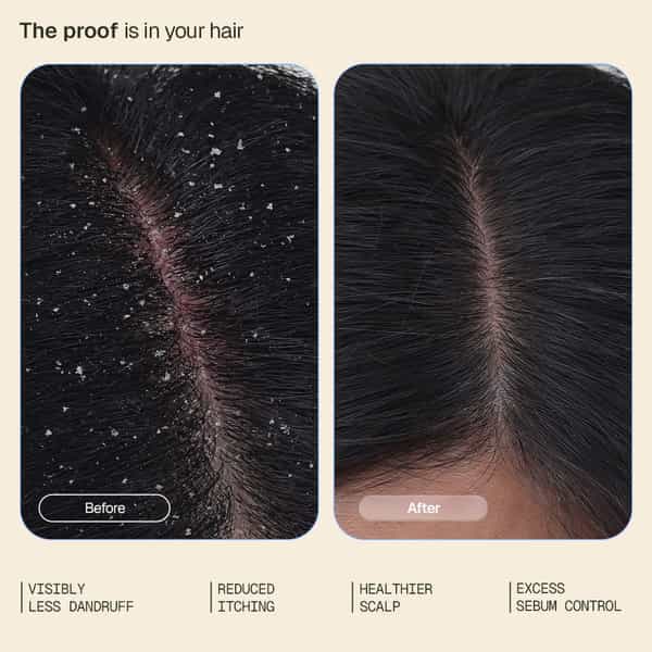 Arata Anti - Dandruff Serum | Controls Dandruff & Relieves Itchy Scalp | 30 Ml