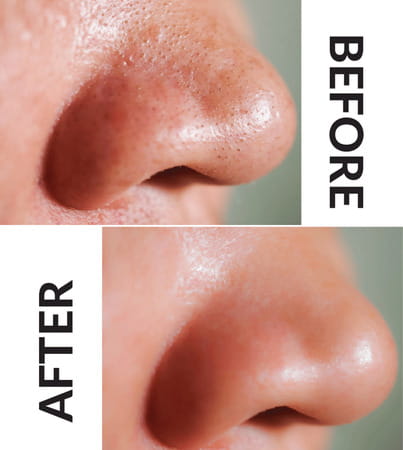 Priveda Charcoal Deep Cleansing Pore Nose Strips For Blackhead Removal (Normal 4)