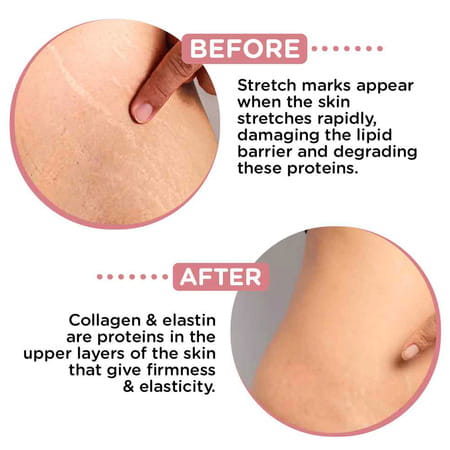 Goodness.Me Stretchmark Oil Super-Blend Of 6 Natural Oils Vegan Suitable For Sensitive Skin-100ml