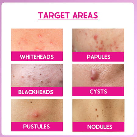 Cos-Iq Abp 11% Beginner Friendly Exfoliating Peel Aha 6% | Ph4% | Bha 1% Peeling Solution