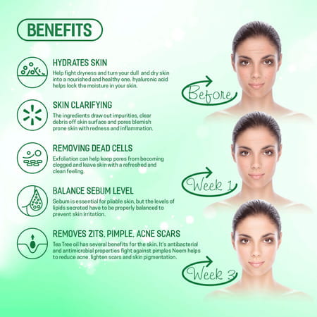 Spantra Anti Acne Facial Serum 50ml