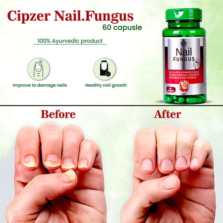 Cipzer Nail Fungus Capsule Eradicate & Safeguard Against Nail,Skin &Toe Fungal Infection 60 Capsules