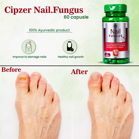 Cipzer Nail Fungus Capsule Eradicate & Safeguard Against Nail,Skin &Toe Fungal Infection 60 Capsules