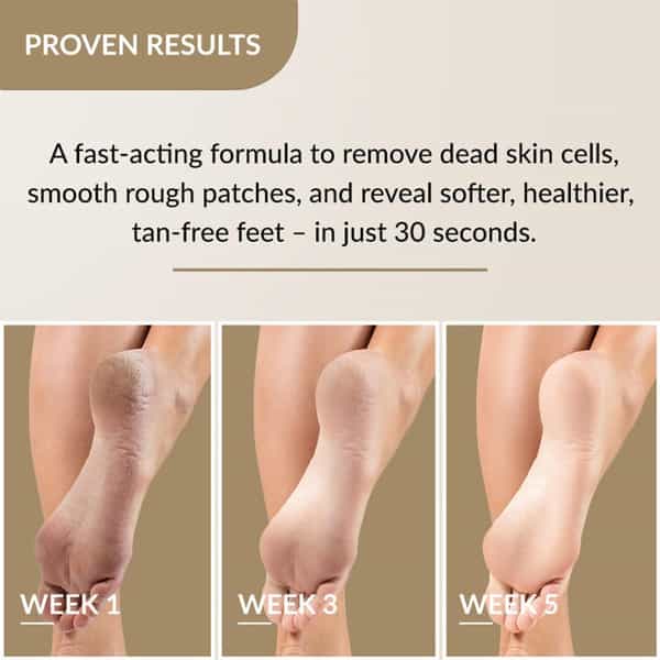 Fixderma Foobetik Foot Scrub Spray Dead Skin & Tan Removal Darkness Blackness Removal Scrub 50 Ml