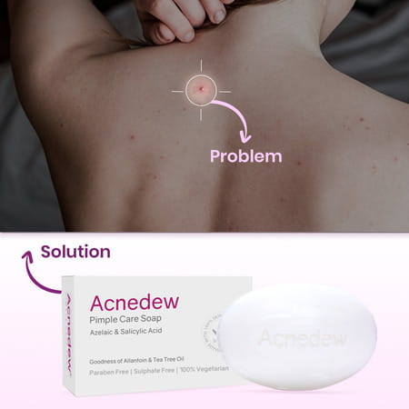 Acnedew Anti Acne & Anti Pimple Soap With Aloe & Tea Tree Oil (100 Gm Pack Of 2)