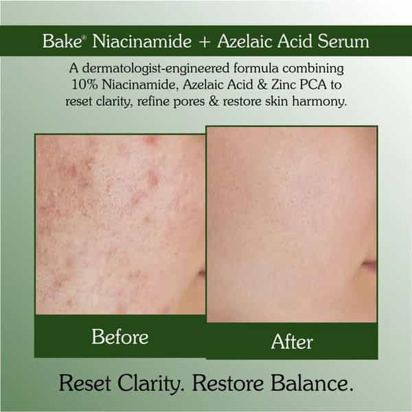 Bake 10% Niacinamide Face Serum With Azelaic For Acne Marks | Dark Spots & Oil Control (30Ml)