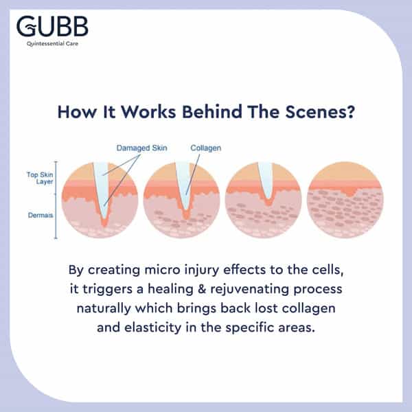 Gubb Derma Roller 0.5Mm For Hair Regrowth Face Acne Scars & Skin Aging 540 Micro Needles - Red