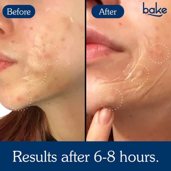 Bake 2% Salicylic Acid Hydrocolloid Acne Patches Xl For Pimples & Blackheads (10 Patches)