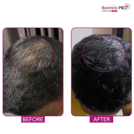 Bontress Pro+ Scalp Serum | 5% Capixyl | 3% Redensyl | 3% Anagain | 3% Procapil | 30 Ml