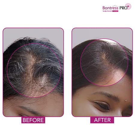 Bontress Pro+ Scalp Serum | 5% Capixyl | 3% Redensyl | 3% Anagain | 3% Procapil | 30 Ml