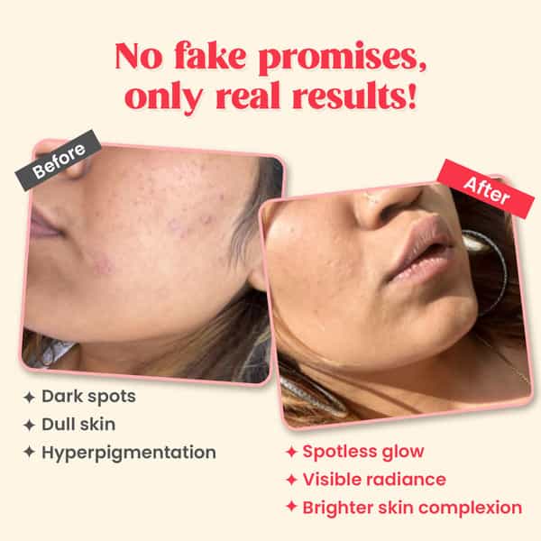 Chicnutrix Outshine-Skin Glow Serum With Vitamin C | Glutathione | Arbutin | Niacinamide