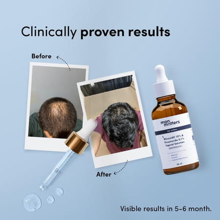 Man Matters Growmax+ Minoxidil 10% With 0.1% Finasteride Serum I Prevent Hair Loss | Thinning | 50ml