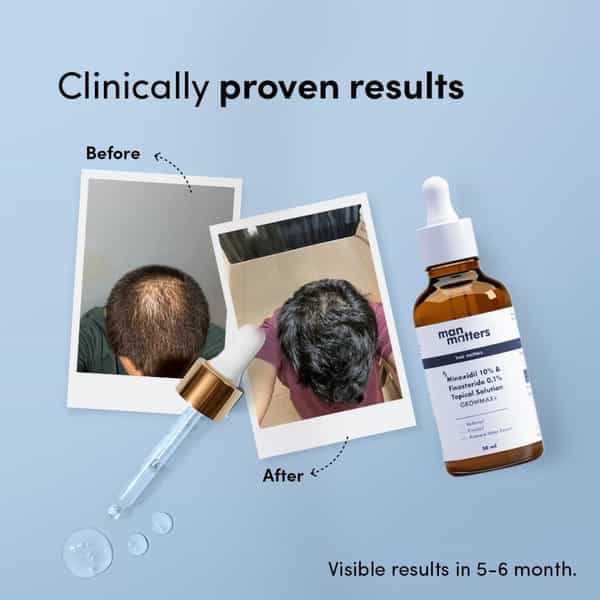 Man Matters Growmax+ Minoxidil 10% With 0.1% Finasteride Serum I Prevent Hair Loss | Thinning | 50Ml
