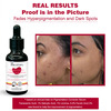 The Skin Story 2% Alpha Arbutin 2% Niacinamide Face Serum For Pigmentation Age Spots Dark Spots 25Ml