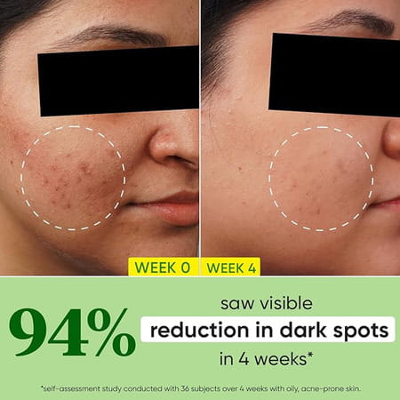 Dot & Key 10% Niacinamide + Cica Serum | Reduces Acne & Dark Spots | 30ml