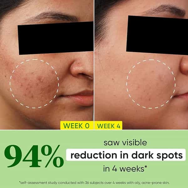 Dot & Key 10% Niacinamide + Cica Serum | Reduces Acne & Dark Spots | 30Ml