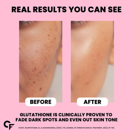 Carbamide Forte L Glutathione With Vitamin C & Amla Extract 1000mg Combi Pack Bottle Of 60 Tablets