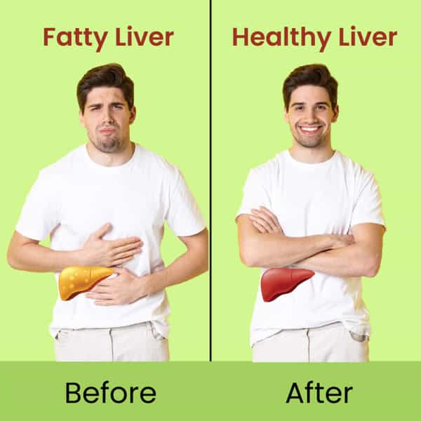 Cipzer Fatty Liver Solution Capsule Manage Fatty Liver Conditions,Supports Liver Health 60 Capsules