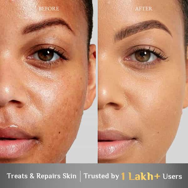 Anti Acne Face Wash 100 Gms Pack Of 2
