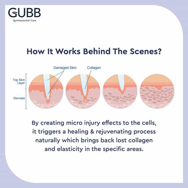 Gubb Usa Derma Roller 0.5Mm For Face Acne Scars Skin Ageing Titanium Micro Needles Red Color
