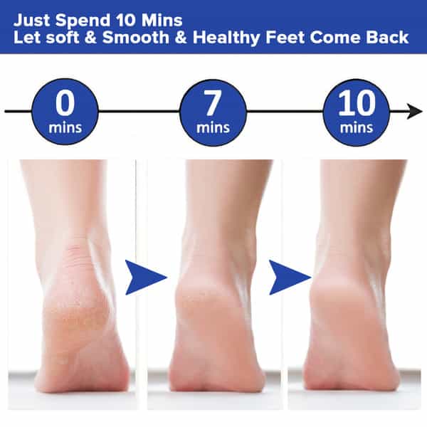 Dr Foot Foot File Callus Remover|Dead Skin, Calluses, Cracked Heels & Hard Skin Remover (Free Brush)