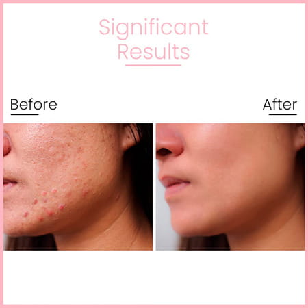 Anveya Goodbye Acne Kit With Face Wash 120ml & Serum 30ml