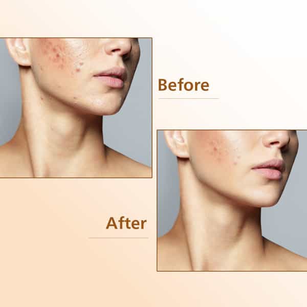 Acnedac Acne Spot Corrector Cream (10 Gm Pack Of 2)