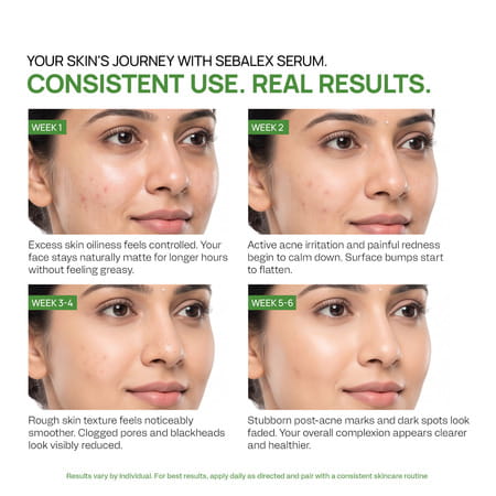 Yuderma Sebalex Acne Creamish Sebum Regulator Gel | 40 Ml