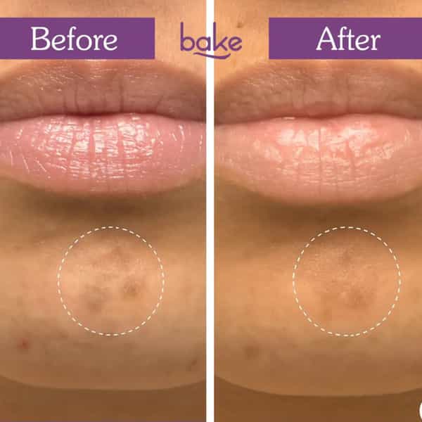 Bake Spot Erase Hydrocolloid Patches For Dark Spots | Acne Marks & Post-Acne Marks (4 Patch)