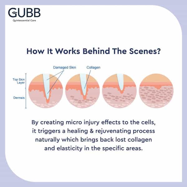 Gubb Derma Roller 0.5Mm For Hair Regrowth Face Acne Scars & Skin Aging 540 Micro Needles - Blue