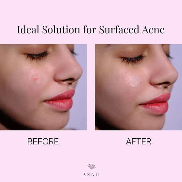 Azah Acne Patch|Transparent Hydrocolloid Patches Quick Acne|60 Patches Of 3 Sizes