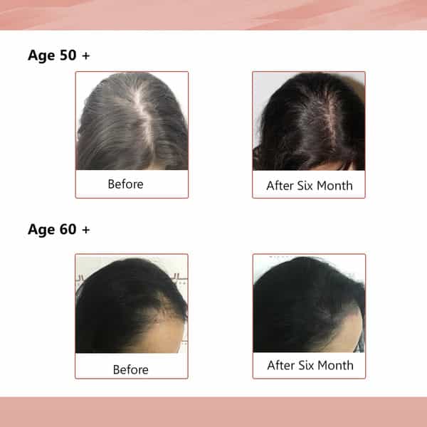 Sheneed Hair Supplement With 11+Nutrients- Vit-B9 & Vit-E (Pack Of 2)
