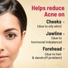 Gynoveda Anti Acne Ayurvedic Medicine Clears Pimples Mark Scars Pigmentation 3 Bottle 720 Tablets