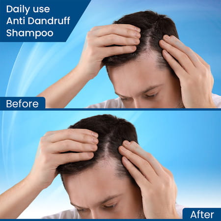 Nizoveil Anti Dandruff Shampoo - 100ml