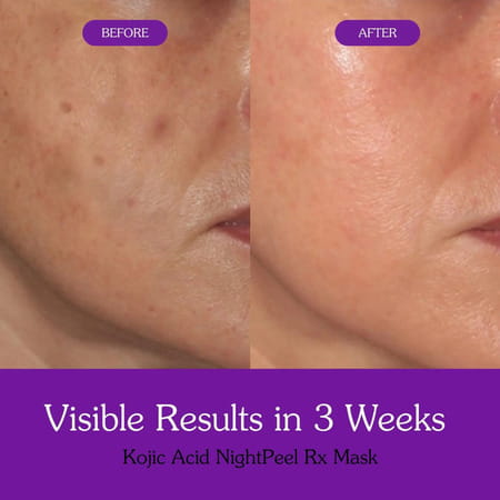 Bake 1% Kojic Acid Night Peel Off Mask With Niacinamide & Turmeric For Dark Spots (100Ml)