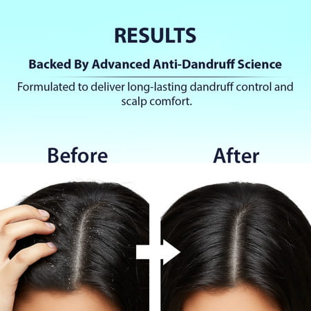 Dermistry Anti Dandruff Piroctone Climbazole Salicylic Acid Hair Serum Flakes Dry Itchy Scalp 50ml