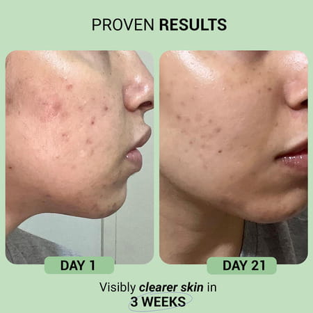 Sereko Skin Clearing Syrup Mixed Berry Flavour Blood Purifier For Acne & Pimple Control 200 Ml