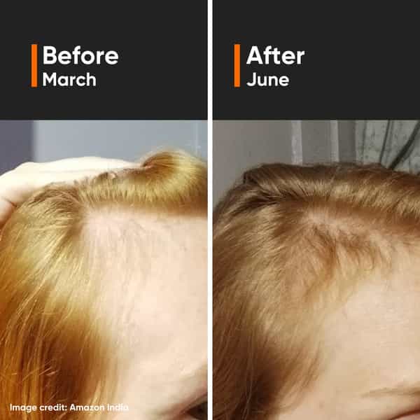 Minimalist Hair Growth Actives 18% Hair Serum (30Ml)