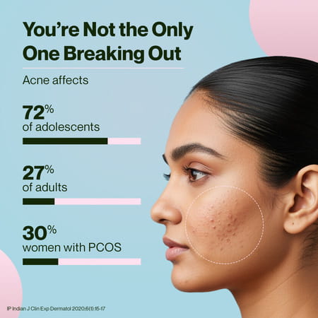 Setu Skin Acneclear+ | Bifiacnel Probiotics | Chasteberry & Chamomile | Green Apple - 30 Sachets