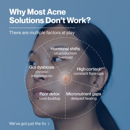 Setu Skin Acneclear+ | Bifiacnel Probiotics | Chasteberry & Chamomile | Green Apple - 30 Sachets