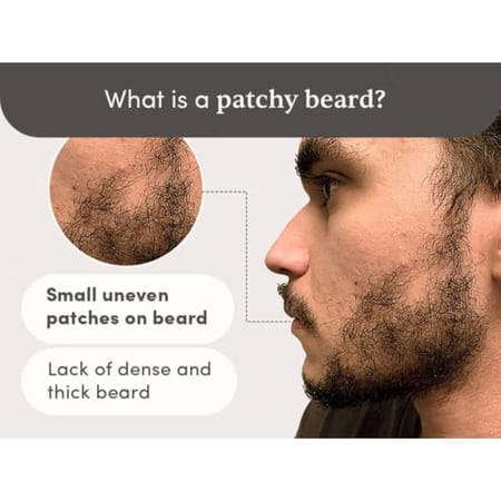 Man Matters Beardmax Growth Serum | 5% Minoxidil | Solves Uneven & Patchy Beard | 30ml