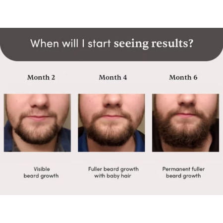 Man Matters Beardmax Growth Serum | 5% Minoxidil | Solves Uneven & Patchy Beard | 30ml