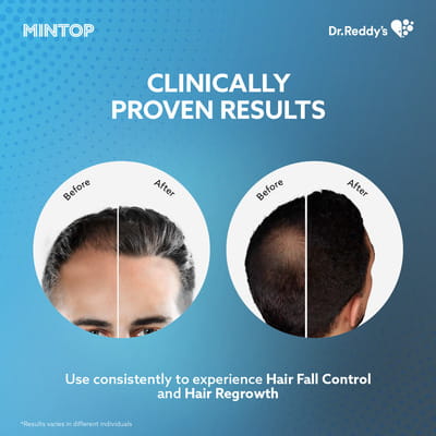 Mintop Forte 5% Minoxidil Bottle Of 60ml Solution