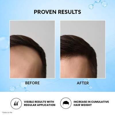 Mintop Forte 5% Minoxidil Bottle Of 120ml Solution