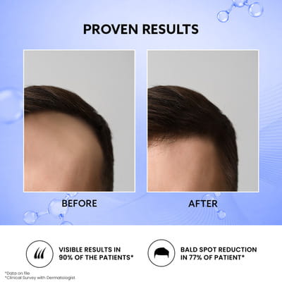 Mintop Forte 10% Bottle Of 120ml Solution